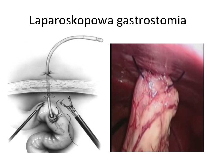 Laparoskopowa gastrostomia 
