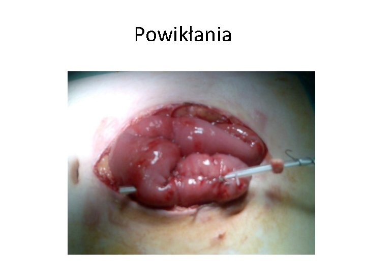 Powikłania 