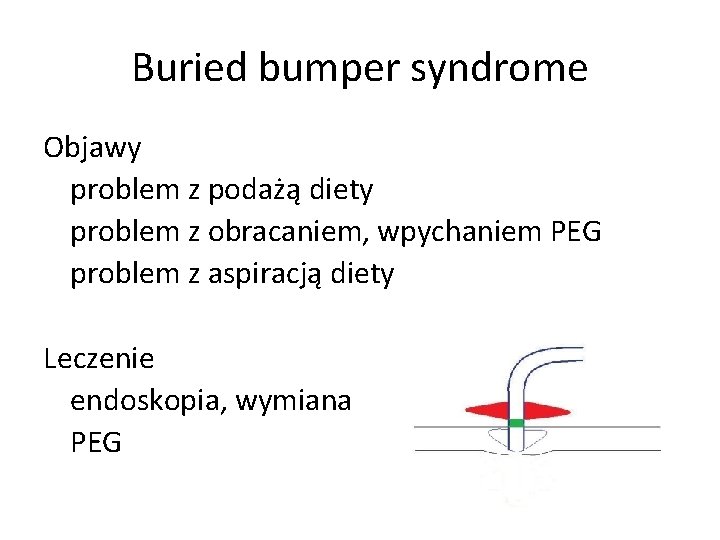 Buried bumper syndrome Objawy problem z podażą diety problem z obracaniem, wpychaniem PEG problem
