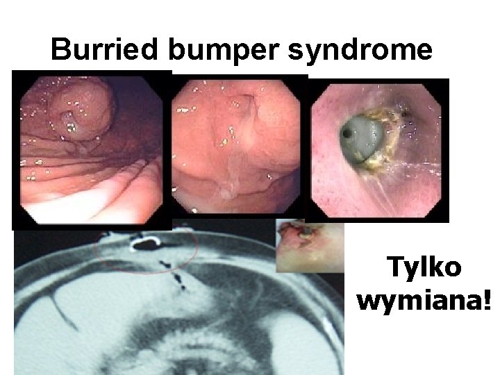 Burried bumper syndrome Tylko wymiana! 