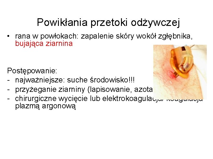 Powikłania przetoki odżywczej • rana w powłokach: zapalenie skóry wokół zgłębnika, bujająca ziarnina Postępowanie: