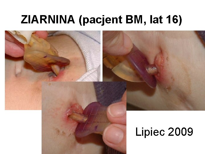 ZIARNINA (pacjent BM, lat 16) Lipiec 2009 