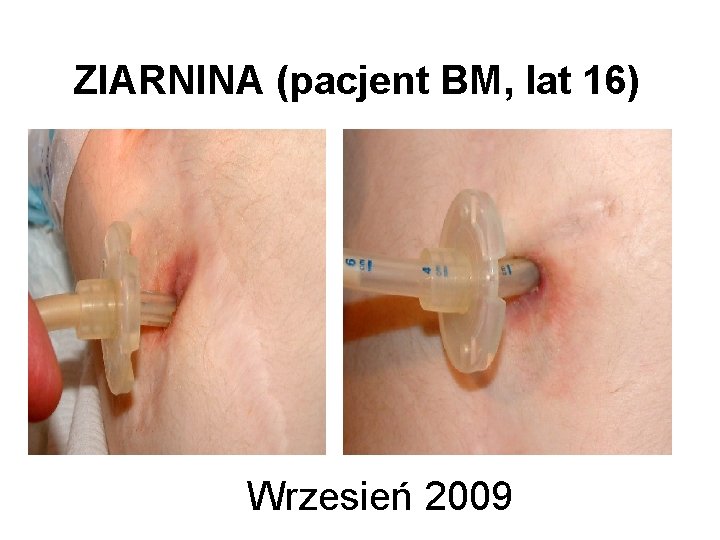 ZIARNINA (pacjent BM, lat 16) Wrzesień 2009 