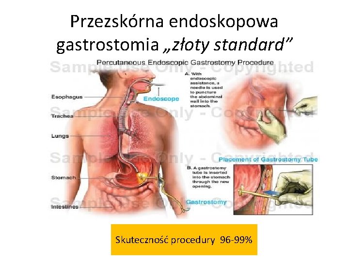 Przezskórna endoskopowa gastrostomia „złoty standard” Skuteczność procedury 96 -99% 