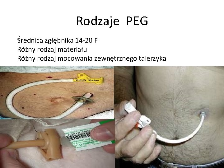 Rodzaje PEG Średnica zgłębnika 14 -20 F Różny rodzaj materiału Różny rodzaj mocowania zewnętrznego