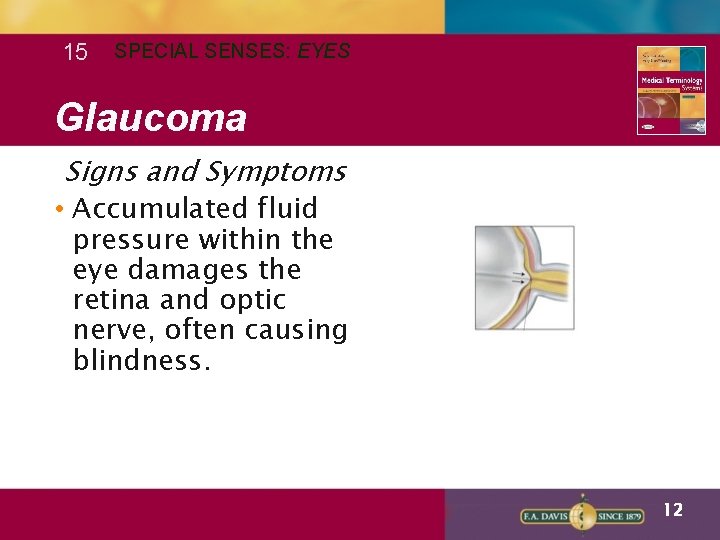 15 SPECIAL SENSES: EYES Glaucoma Signs and Symptoms • Accumulated fluid pressure within the