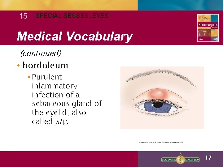 15 SPECIAL SENSES: EYES Medical Vocabulary (continued) • hordoleum • Purulent inlammatory infection of