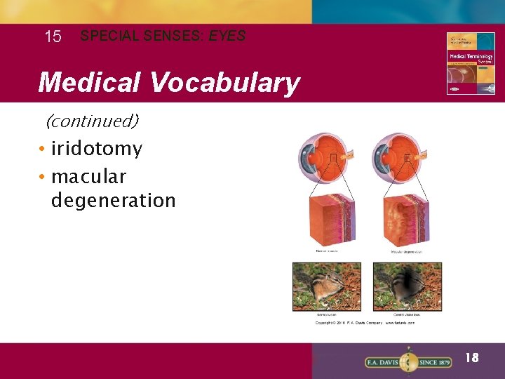 15 SPECIAL SENSES: EYES Medical Vocabulary (continued) • iridotomy • macular degeneration 18 