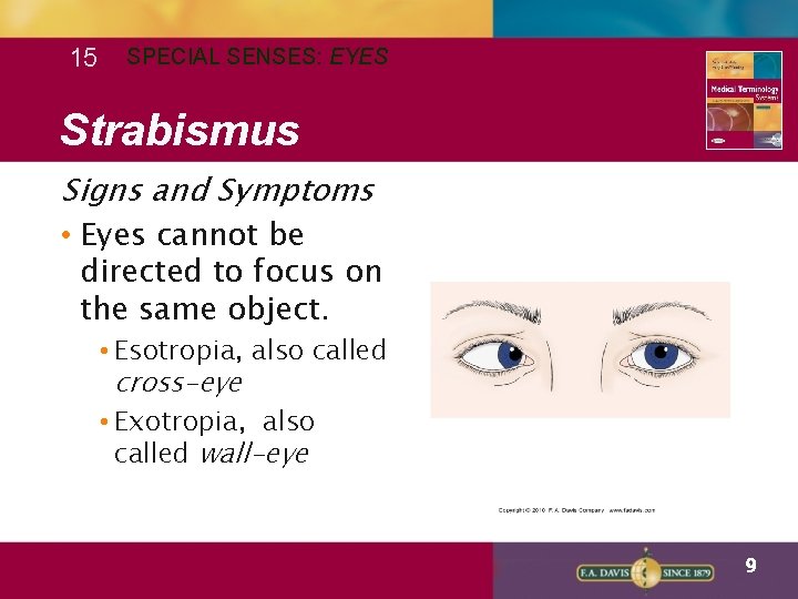 15 SPECIAL SENSES: EYES Strabismus Signs and Symptoms • Eyes cannot be directed to