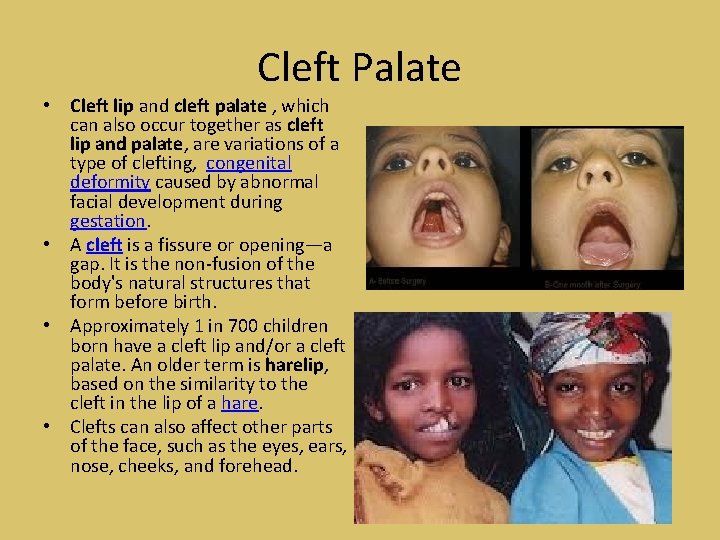 Cleft Palate • Cleft lip and cleft palate , which can also occur together