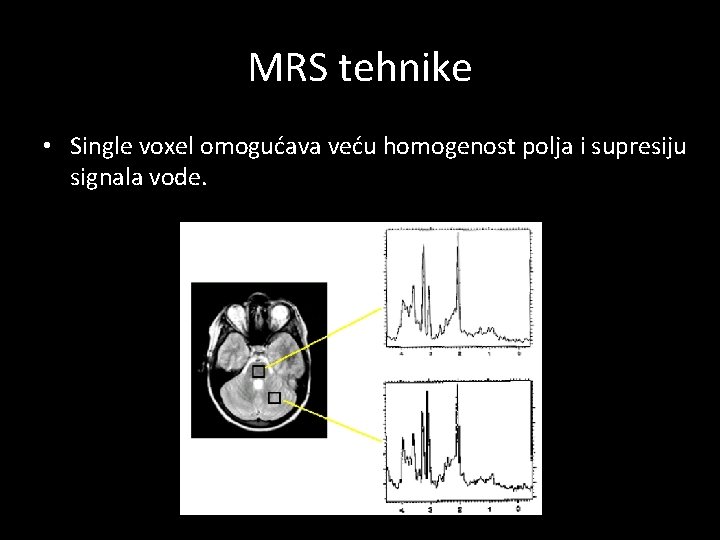 MRS tehnike • Single voxel omogućava veću homogenost polja i supresiju signala vode. 