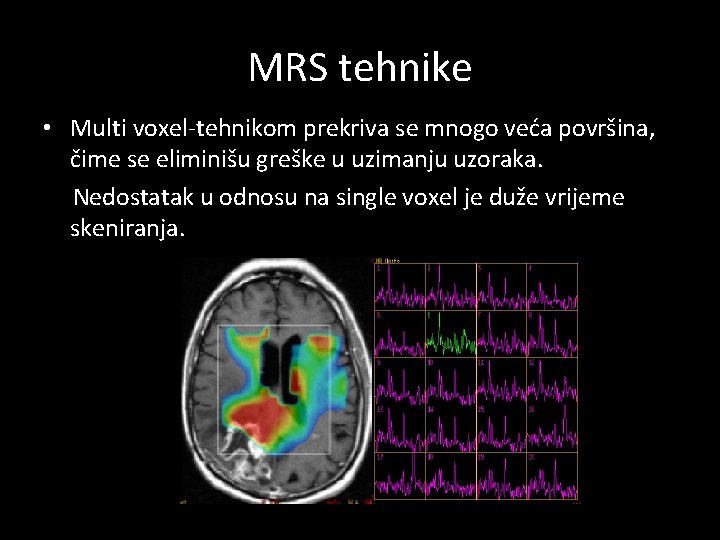 MRS tehnike • Multi voxel-tehnikom prekriva se mnogo veća površina, čime se eliminišu greške