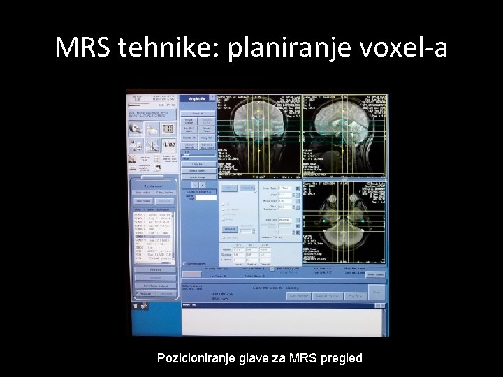 MRS tehnike: planiranje voxel-a Pozicioniranje glave za MRS pregled 