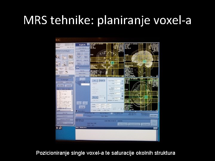 MRS tehnike: planiranje voxel-a Pozicioniranje single voxel-a te saturacije okolnih struktura 