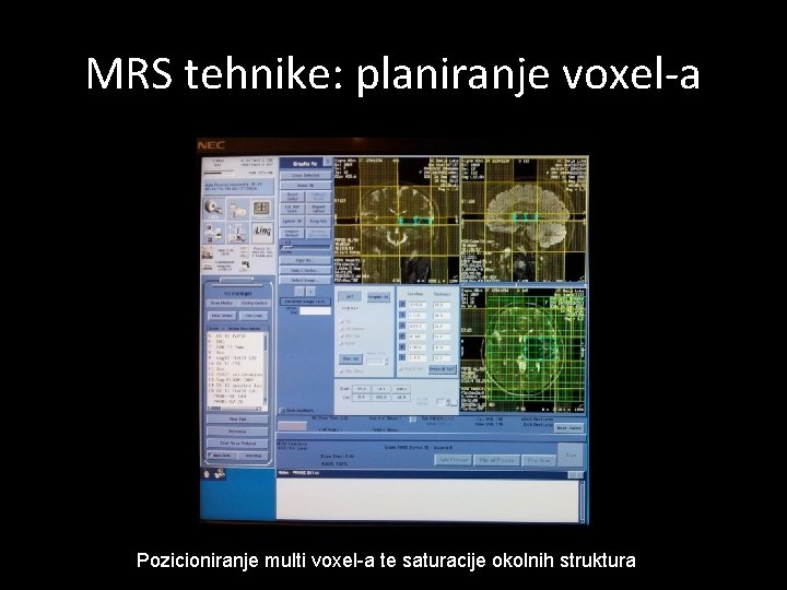 MRS tehnike: planiranje voxel-a Pozicioniranje multi voxel-a te saturacije okolnih struktura 