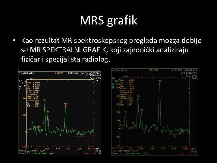 MRS grafik • Kao rezultat MR spektroskopskog pregleda mozga dobije se MR SPEKTRALNI GRAFIK,