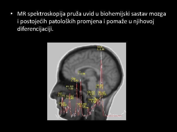  • MR spektroskopija pruža uvid u biohemijski sastav mozga i postojećih patoloških promjena