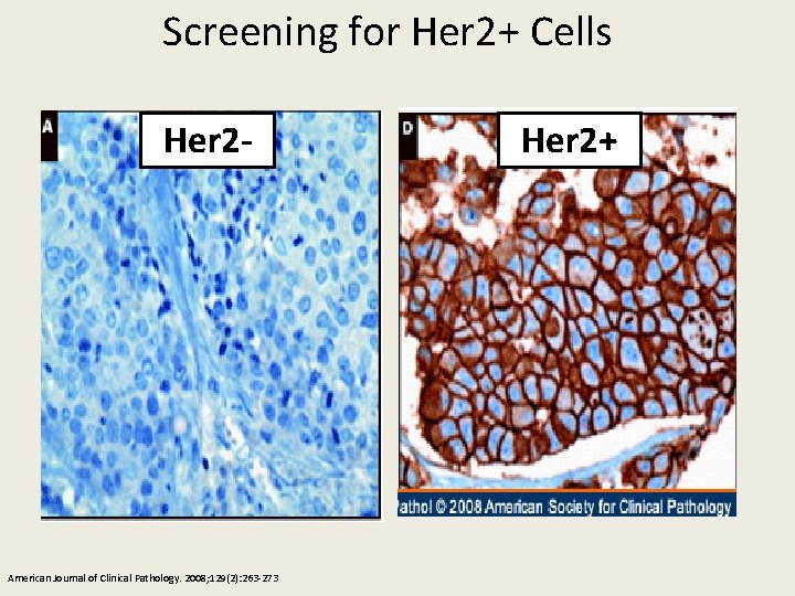 Screening for Her 2+ Cells Her 2 - American Journal of Clinical Pathology. 2008;