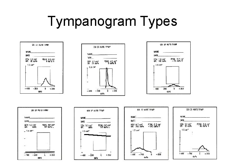 Tympanogram Types 