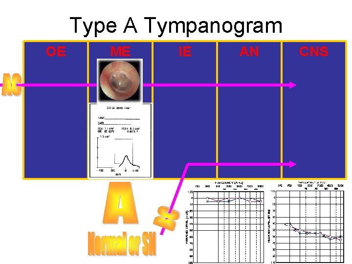 Type A Tympanogram OE ME IE AN CNS Type A Tympanogram OE ME IE AN CNS