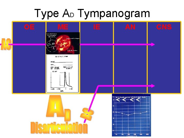 Type AD Tympanogram OE ME IE AN CNS Type AD Tympanogram OE ME IE AN CNS