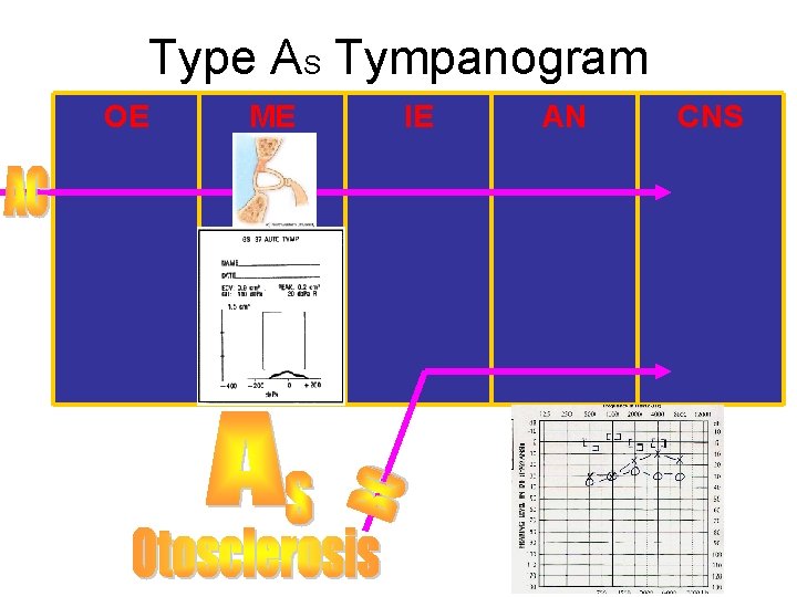 Type AS Tympanogram OE ME IE AN CNS Type AS Tympanogram OE ME IE AN CNS
