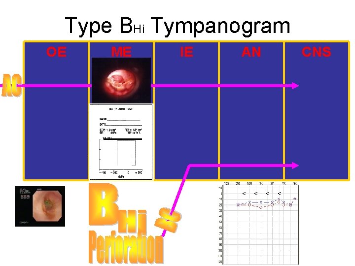 Type BHi Tympanogram OE ME IE AN CNS 