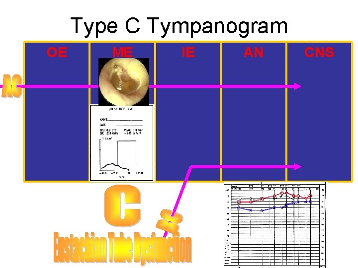 Type C Tympanogram OE ME IE AN CNS 