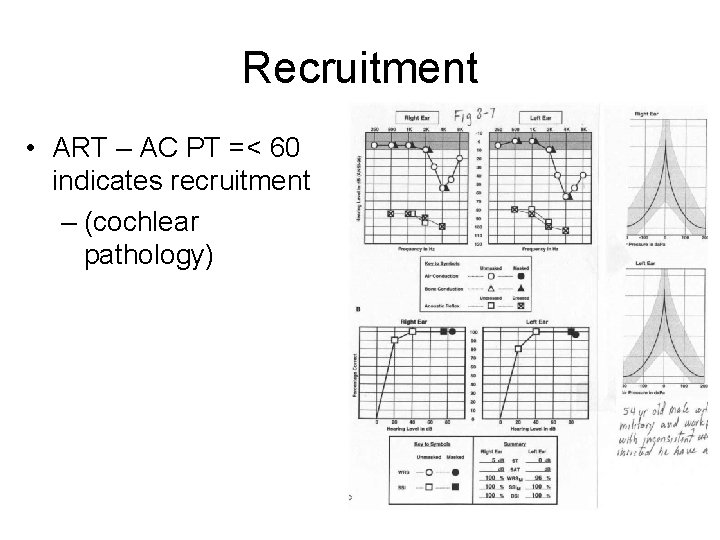 Recruitment • ART – AC PT =< 60 indicates recruitment – (cochlear pathology) Recruitment • ART – AC PT =< 60 indicates recruitment – (cochlear pathology)