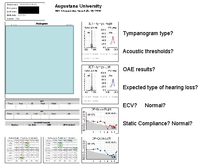 Tympanogram type? Acoustic thresholds? OAE results? Expected type of hearing loss? ECV? Normal? Static Tympanogram type? Acoustic thresholds? OAE results? Expected type of hearing loss? ECV? Normal? Static