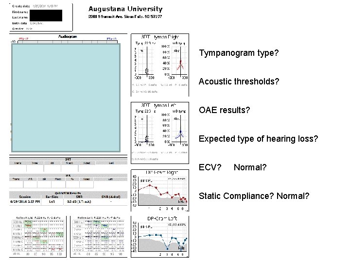 Tympanogram type? Acoustic thresholds? OAE results? Expected type of hearing loss? ECV? Normal? Static Tympanogram type? Acoustic thresholds? OAE results? Expected type of hearing loss? ECV? Normal? Static