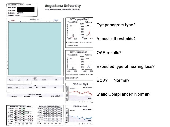 Tympanogram type? Acoustic thresholds? OAE results? Expected type of hearing loss? ECV? Normal? Static