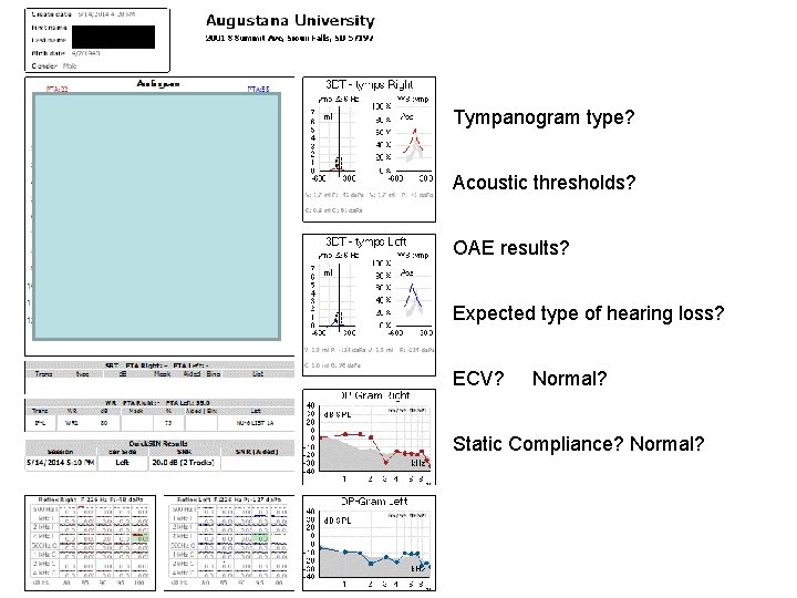 Tympanogram type? Acoustic thresholds? OAE results? Expected type of hearing loss? ECV? Normal? Static