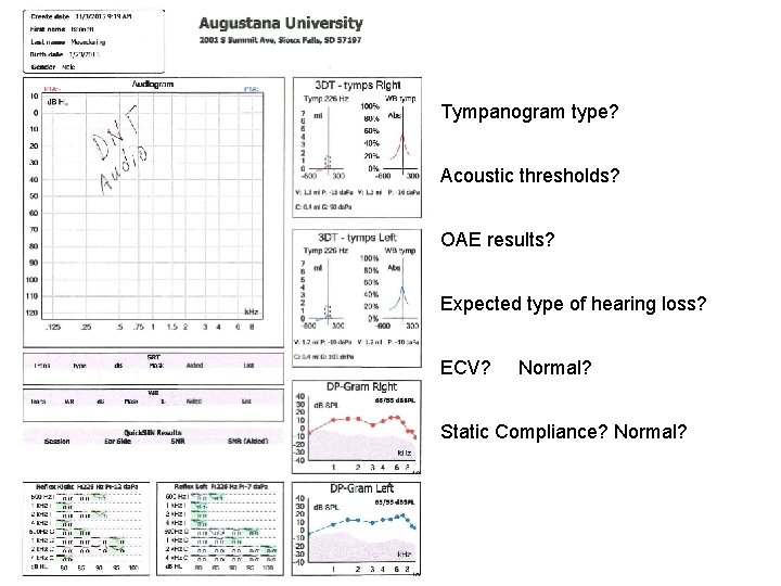 Tympanogram type? Acoustic thresholds? OAE results? Expected type of hearing loss? ECV? Normal? Static