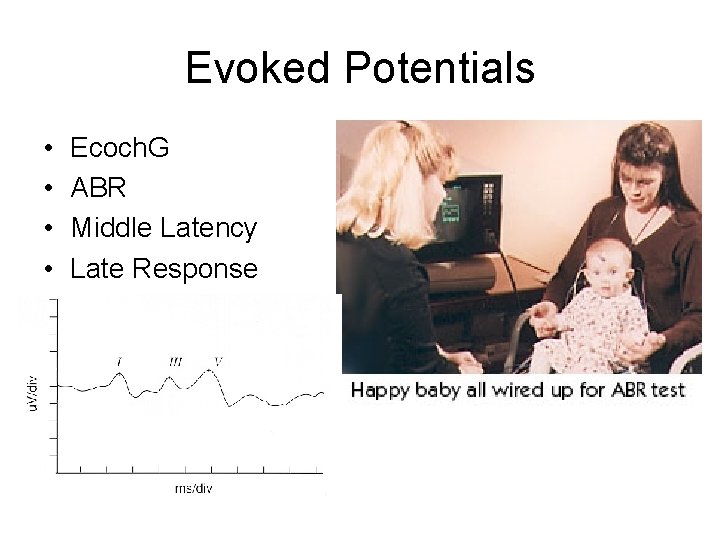 Evoked Potentials • • Ecoch. G ABR Middle Latency Late Response 