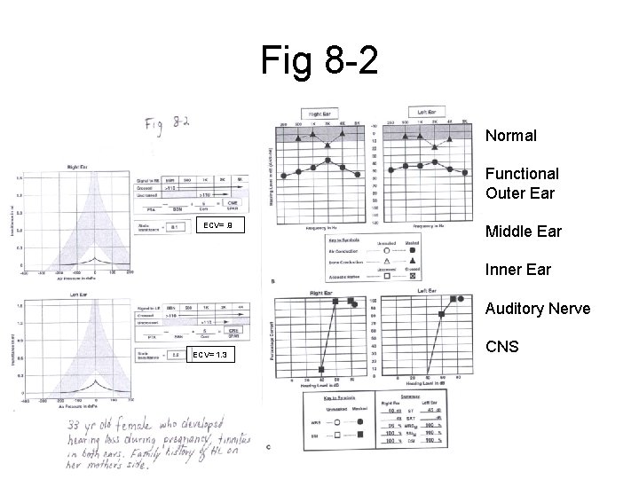 Fig 8 -2 Normal Functional Outer Ear ECV=. 9 Middle Ear Inner Ear Auditory