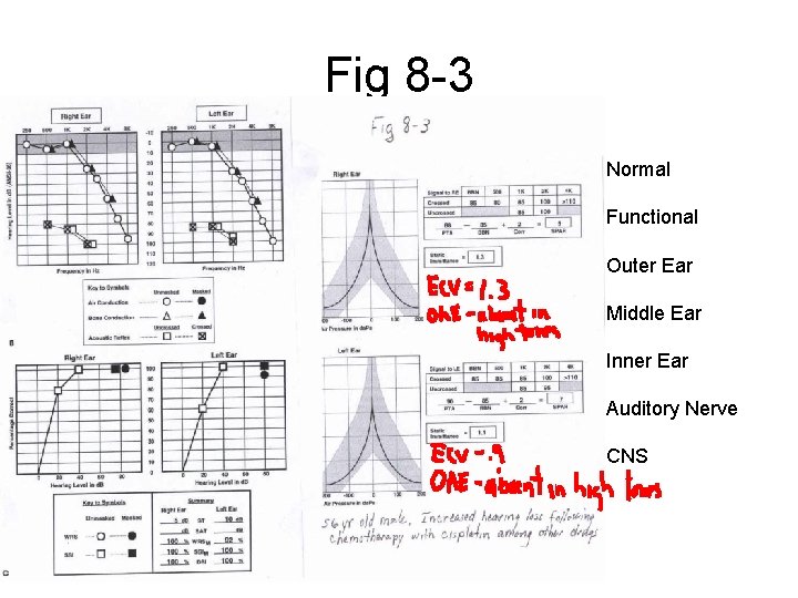 Fig 8 -3 Normal Functional Outer Ear Middle Ear Inner Ear Auditory Nerve CNS