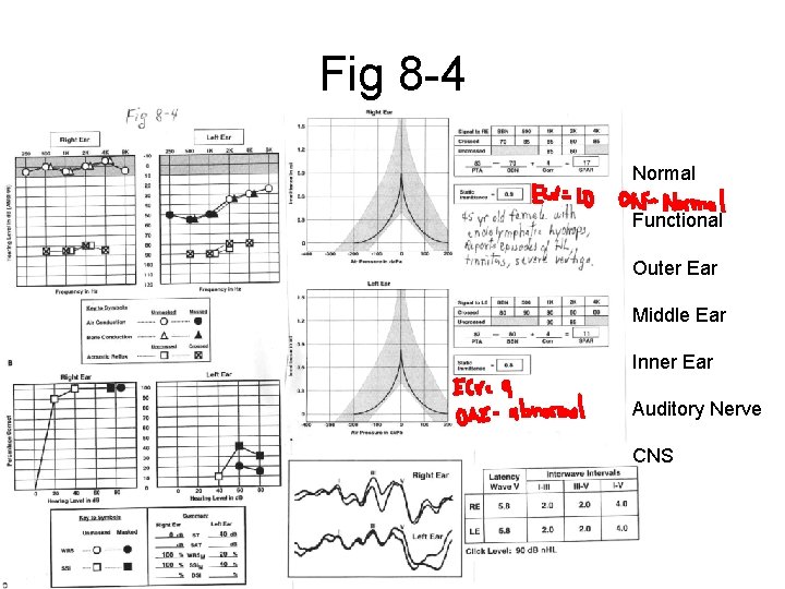 Fig 8 -4 Normal Functional Outer Ear Middle Ear Inner Ear Auditory Nerve CNS Fig 8 -4 Normal Functional Outer Ear Middle Ear Inner Ear Auditory Nerve CNS