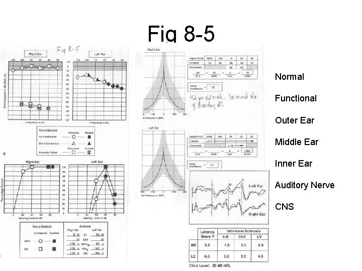 Fig 8 -5 Normal Functional Outer Ear Middle Ear Inner Ear Auditory Nerve CNS