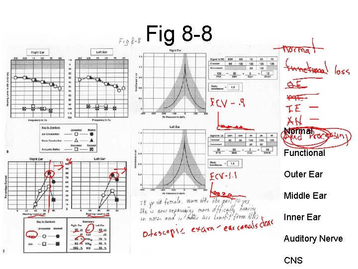 Fig 8 -8 Normal Functional Outer Ear Middle Ear Inner Ear Auditory Nerve CNS