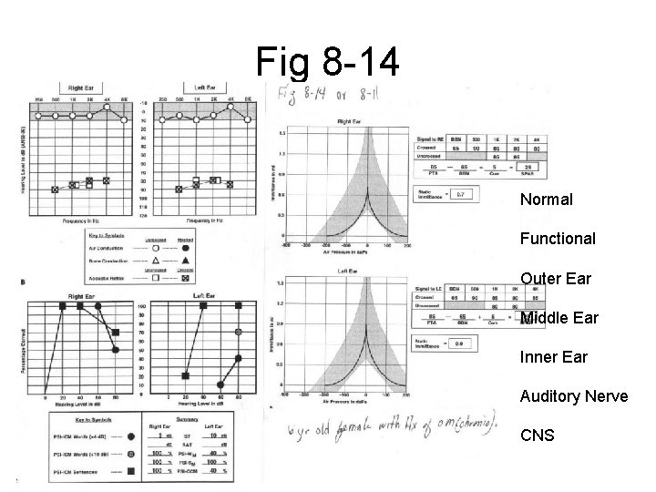 Fig 8 -14 Normal Functional Outer Ear Middle Ear Inner Ear Auditory Nerve CNS