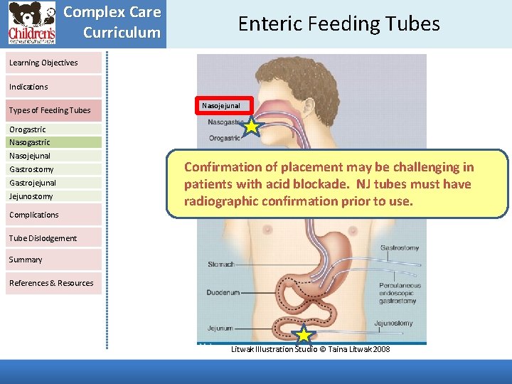 Complex Care Curriculum Enteric Feeding Tubes Learning Objectives Indications Types of Feeding Tubes Nasojejunal