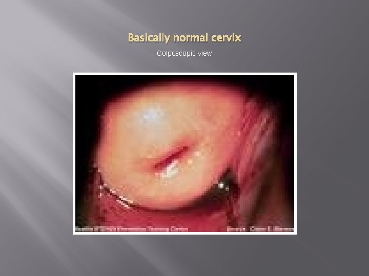 Basically normal cervix Colposcopic view Basically normal cervix Colposcopic view