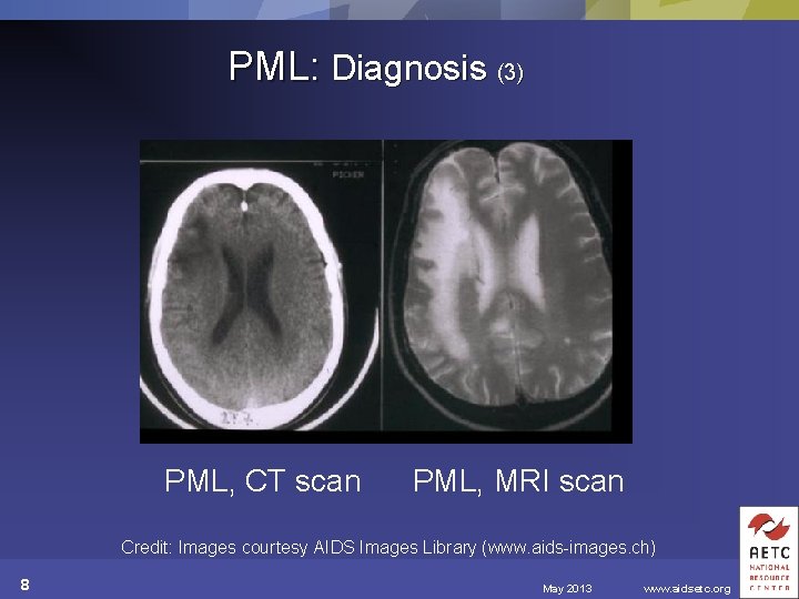 PML: Diagnosis (3) PML, CT scan PML, MRI scan Credit: Images courtesy AIDS Images