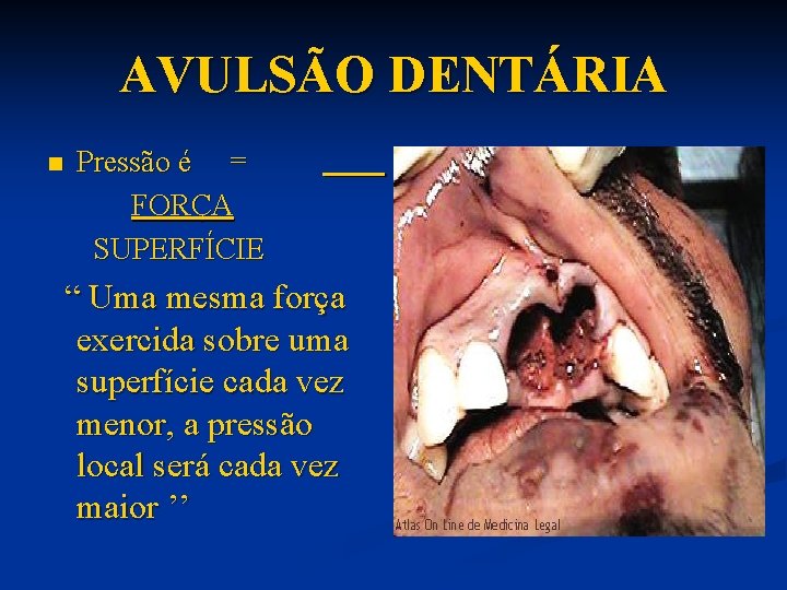AVULSÃO DENTÁRIA n Pressão é = FORÇA SUPERFÍCIE “ Uma mesma força exercida sobre