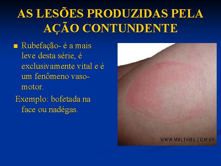 AS LESÕES PRODUZIDAS PELA AÇÃO CONTUNDENTE Rubefação- é a mais leve desta série, é