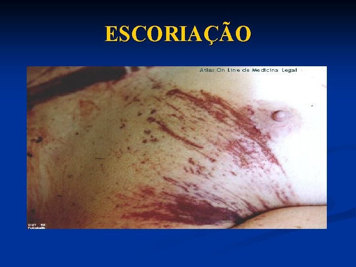 ESCORIAÇÃO 
