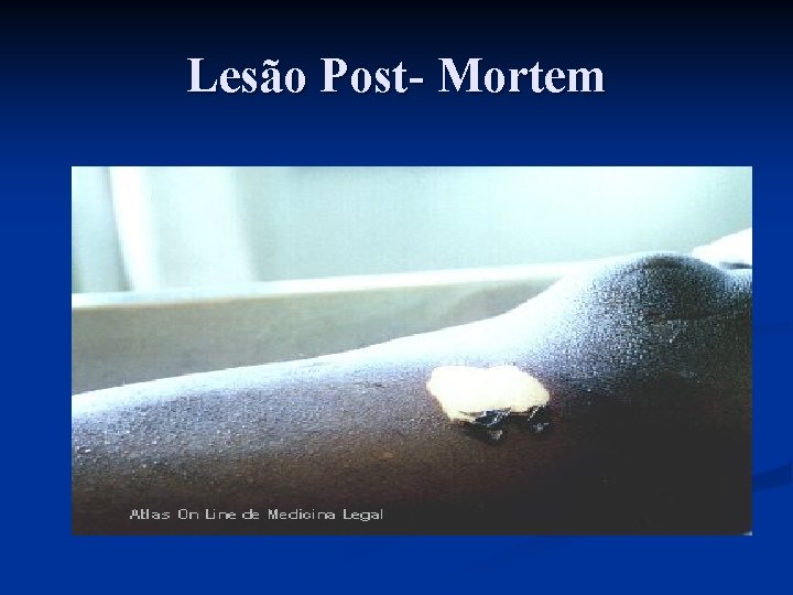 Lesão Post- Mortem 