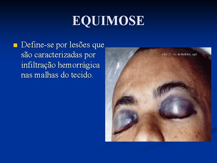 EQUIMOSE n Define-se por lesões que são caracterizadas por infiltração hemorrágica nas malhas do
