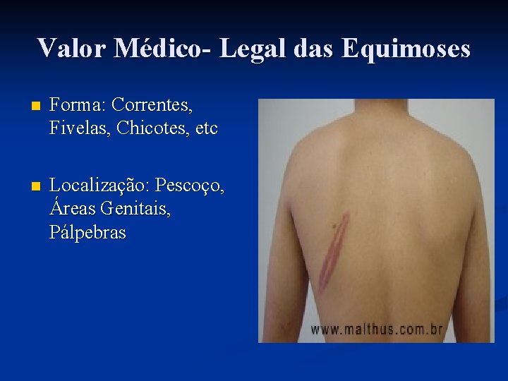 Valor Médico- Legal das Equimoses n Forma: Correntes, Fivelas, Chicotes, etc n Localização: Pescoço,